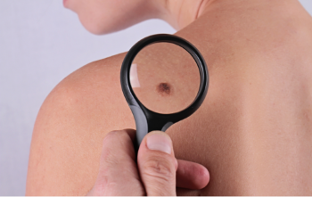 Melanomas