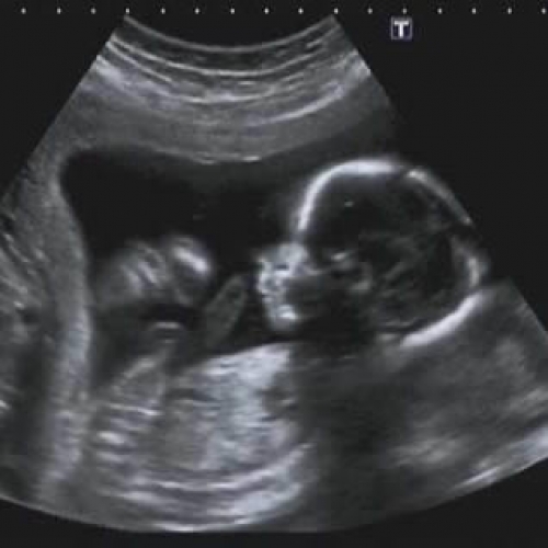 Ultrassonografia Obstétrica